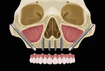 blog image